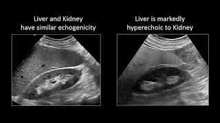 GI Imaging  Hepatic Steatosis and Cirrhosis [upl. by Madlen440]