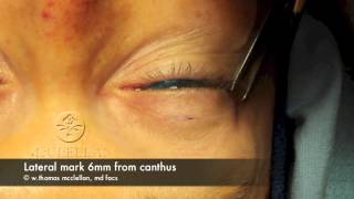 Live Surgery Upper Blepharoplasty Eyelid Lift Part 1 Markings and Anesthesia [upl. by Notlrahc635]