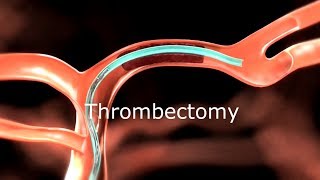 Thrombectomy Animation [upl. by Atisusej]