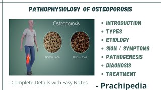 Osteoporosis  Causes Symptoms Diagnosis Treatment [upl. by Ylnevaeh]