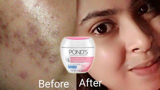 Best Dark Spot Remover Cream 2021 [upl. by Oigres931]