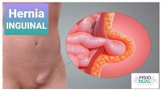 Ejercicios para Hernia Inguinal [upl. by Doro]