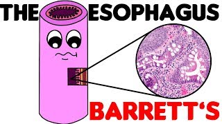 Esophagus Histology  3 Barretts Esophagus [upl. by Ploch]