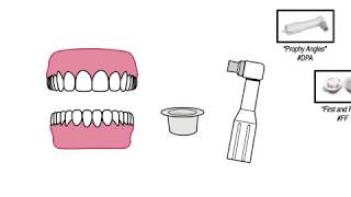 Bonding to Ceramic Crowns Porcelain Lithium Disilicate Zirconia [upl. by Narrat739]