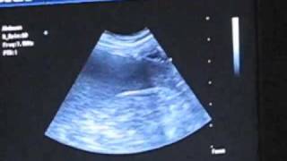 Splenic Tumor Ultrasound Diagnosis by Dr Pam [upl. by Lindo]