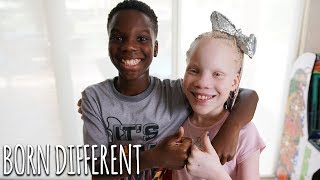 My Twin Sister Has Albinism  BORN DIFFERENT [upl. by Areta]