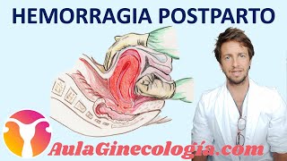 HEMORRAGIA POSTPARTO CAUSAS y TRATAMIENTOS que pueden SALVAR VIDAS  Ginecología y Obstetricia [upl. by Twelve846]