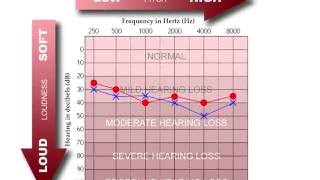 How to Read an Audiogram [upl. by Hallvard]