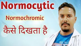 normocytic normochromic in hindi  Normocytic anemia  RBC indices in hindi [upl. by Atteselrahc]