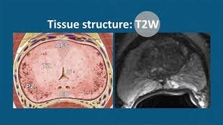 Multiparametric MRI to Detect Clinically Significant Prostate Cancer What Urologists Need to Know [upl. by Atirec342]