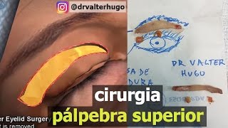 CIRURGIA Palpebras Caidas Antes Depois e Preço Blefaroplastia  Dr Valter [upl. by Eloccin]