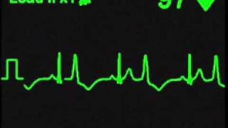 Ventricular Bigeminy  ECG Simulator  Arrhythmia Simulator [upl. by Manuel580]