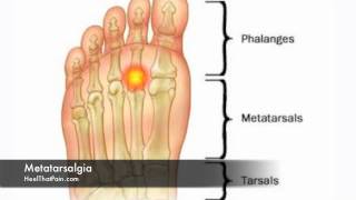 Metatarsalgia Foot Pain Causes Symptoms amp Treatments [upl. by Ahsam]