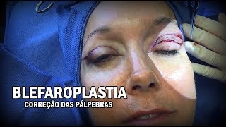 Cirurgia  Blefaroplastia  Cirurgia Plástica das Pálpebras ᴴᴰ [upl. by Cornew273]