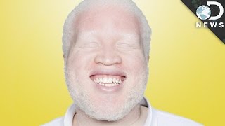 Why Are Some People Albino [upl. by Heger]