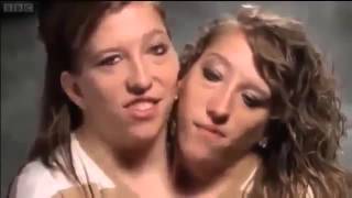 Abby and Brittany Joined for Life Episode 5 BBC Three 25 01 2014 [upl. by Gaither]