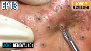 Cystic Acne Extraction 32mn  Blackheads Removal by ACNEREMOVAL101 [upl. by Leitnahs]