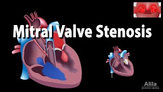 Mitral Valve Stenosis Animation [upl. by Esli]