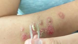 Petroleum Jelly  Tweezers vs Barnacles Psoriasis [upl. by Arehsat]