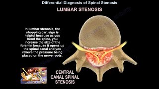 Foraminal Stenosis Problems and Treatments Part 2 [upl. by Sremmus]