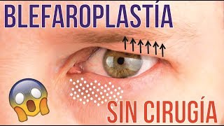 BLEFAROPLASTÍA SIN CIRUGÍA MEDIANTE LASER CO2 FRACCIONADO 💕 DR ALBERTO CALVO QUIROZ [upl. by Myca]