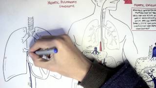 Liver Cirrhosis [upl. by Ahsoyem]