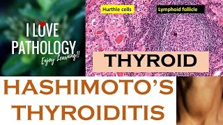 HASHIMOTOS THYROIDITIS Etiopathogenesis Morphology amp Complications [upl. by Adnauq]