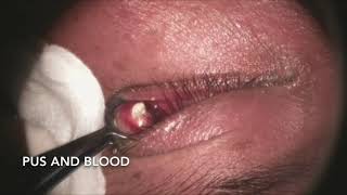 Incision and Drainage of Chalazion [upl. by Brader]