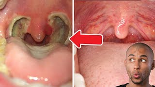 Tonsil Stone  Tonsillectomy [upl. by Eittocs]