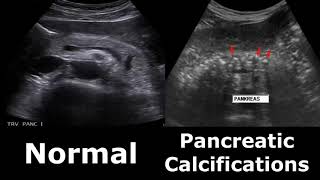 Pancreas Ultrasound Normal Vs Abnormal Appearances Comparison Pancreas Pathologies On Ultrasound [upl. by Merkle220]