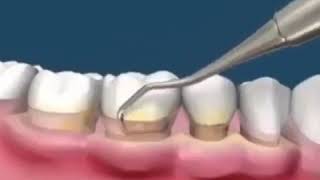 Teeth scaling and polishing [upl. by Ariaec]