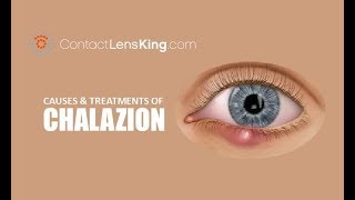 Chalazion  Causes Treatment and Surgery [upl. by Neelear]