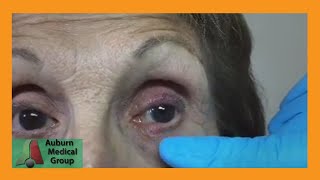 A Stye and a Chalazion  Auburn Medical Group [upl. by Atiroc625]