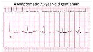 ECG in 60s  Case of quotquotVentricular Bigeminyquot [upl. by Favien447]