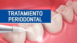 Tratamiento Periodontal  Odontoespecialistas [upl. by Natal622]