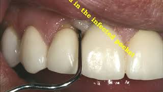 Periodontal Abcess treated with laser dentistry [upl. by Colston256]