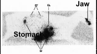 Amalgam Fillings amp Mercury Poisoning [upl. by Donnenfeld]