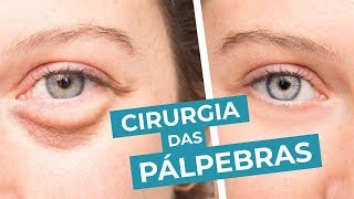 CIRURGIA DAS PÁLPEBRAS ou BLEFAROPLASTIA para tirar aparência de cansaço [upl. by Rambort229]