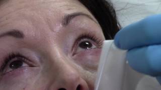 Blephex Blepharitis Treatment at Face amp Eye [upl. by Ahsenrad]