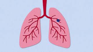 Fibrosis Explained [upl. by Valida]