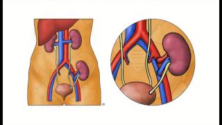 Kidney Transplantation  The Operation [upl. by Bowe]