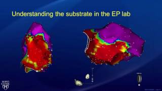 My SVT catheter ablation experience [upl. by Ydnyl249]