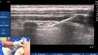 UltrasoundGuided Paravertebral Block [upl. by Anirtik]