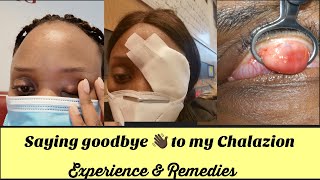 CHALAZION REMOVAL  EYE SURGERY MY EXPERIENCE amp REMEDIES [upl. by Huskamp]