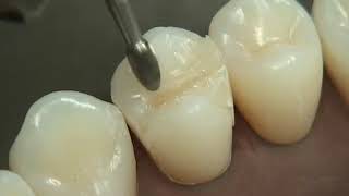 Class II Composite Preparation amp Restoration  Operative Dentistry [upl. by Angelica]