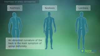 Spinal Deformities Symptoms [upl. by Willner]