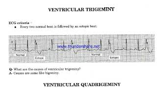 Ventricular Bigeminy Trigeminy amp Quadrigeminy [upl. by Budd335]