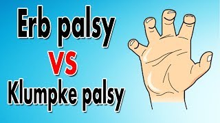 Erbs Palsy explained Brachial Plexus Injury [upl. by Langdon]