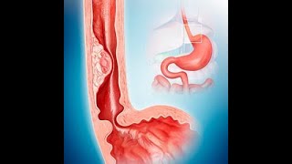 Diseases of the esophagus part 1 by ASM Minds [upl. by Nyrehtak]