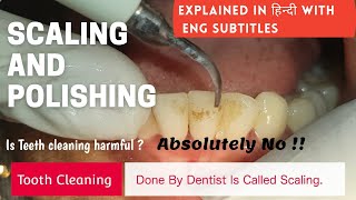 How Scaling is done   Teeth cleaning  Scaling and Polishing [upl. by Kirsti]